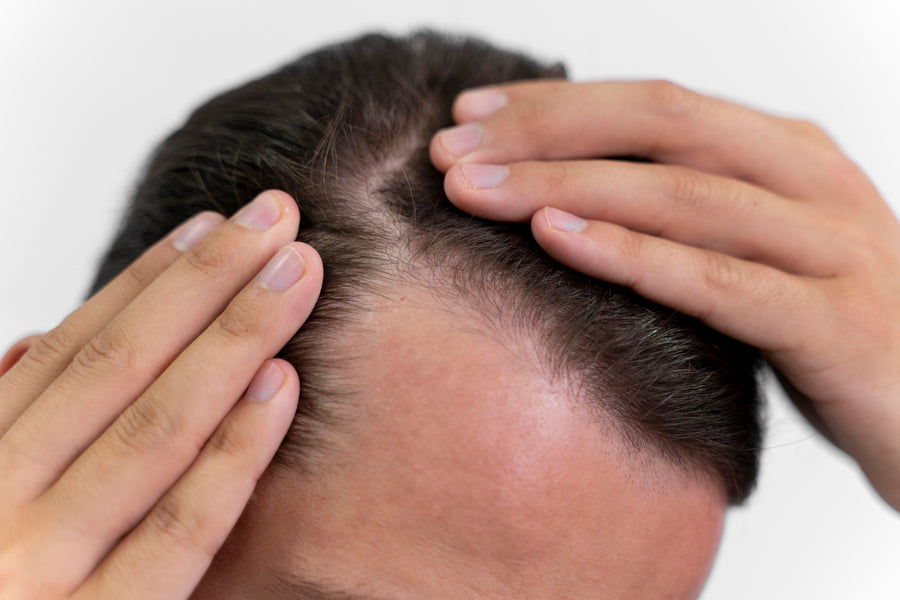 Before - Hairline, Redining.